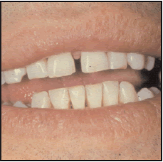 Smoker's teeth after quitting