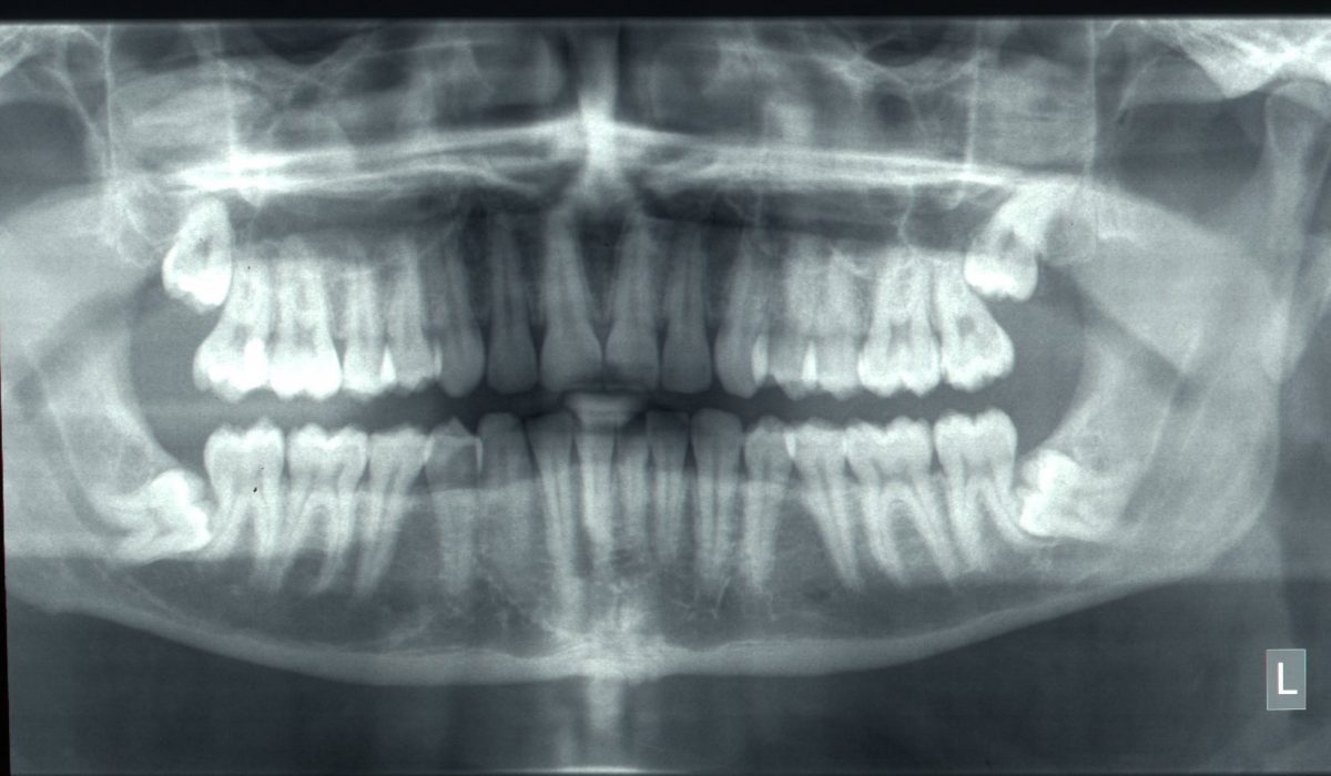 X-ray of impacted wisdom teeth