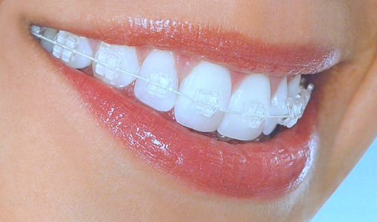 Image of woman's smile with invisible braces