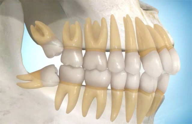 3 Signs of Wisdom Teeth Extraction